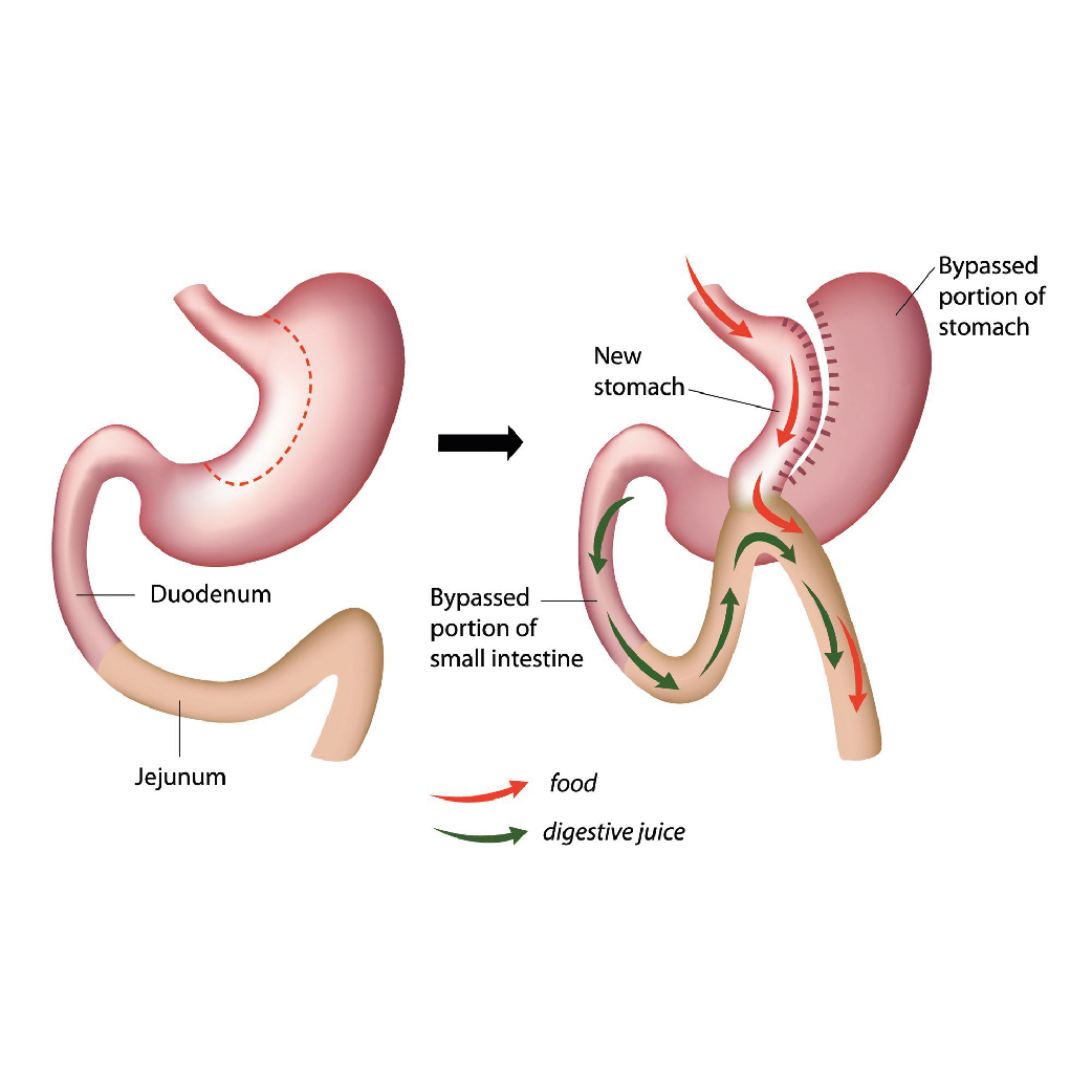 Gastric Bypass Concorde Beauty gastric-bypass-concorde-beauty